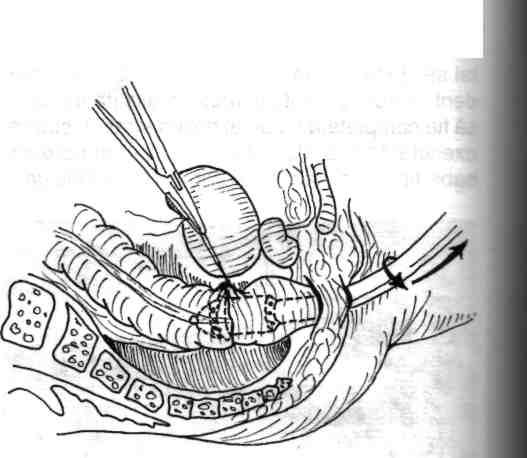 92 Chirurgia colonului, rectului şi canalului anal Fig. 4.109 - Anvil-u\ sfap/er-ului circular este introdus în extremitatea colonică de anastomozat sub protecţia unei burse.
