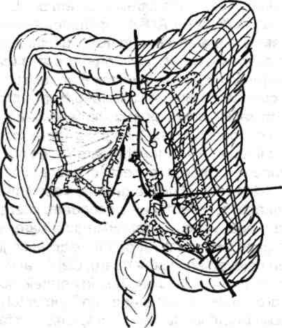94 Chirurgia colonului, rectului şi canalului ana şi, în cele din urmă, tot în ganglionii nilului splenic.