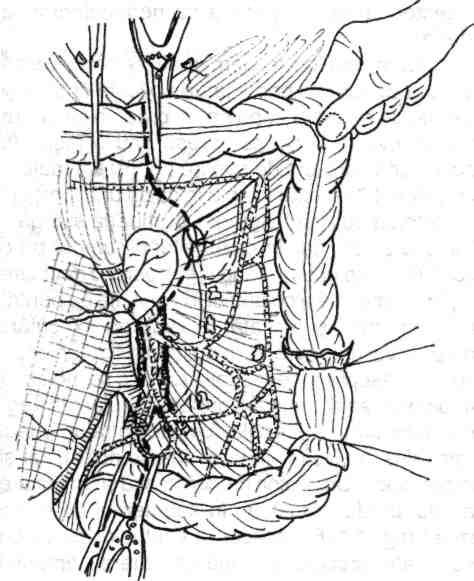 96 Chirurgia colonului, rectului şi canalului anal în evidenţă, ligatura sau pensarea şi secţionarea, conform principiilor deja prezentate, a arterei mezenterice inferioare cât mai aproape de