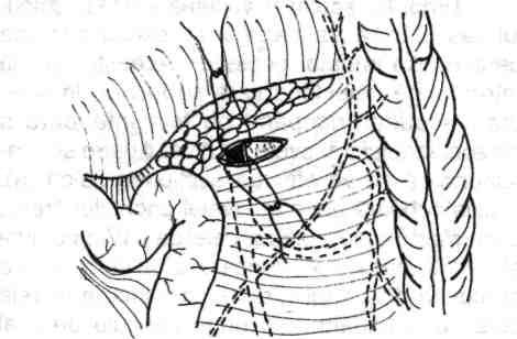 Se ligaturează şi se secţionează vena mezenterică inferioară înainte ca aceasta să dispară în profunzime, posterior de pancreas (fig. 4.