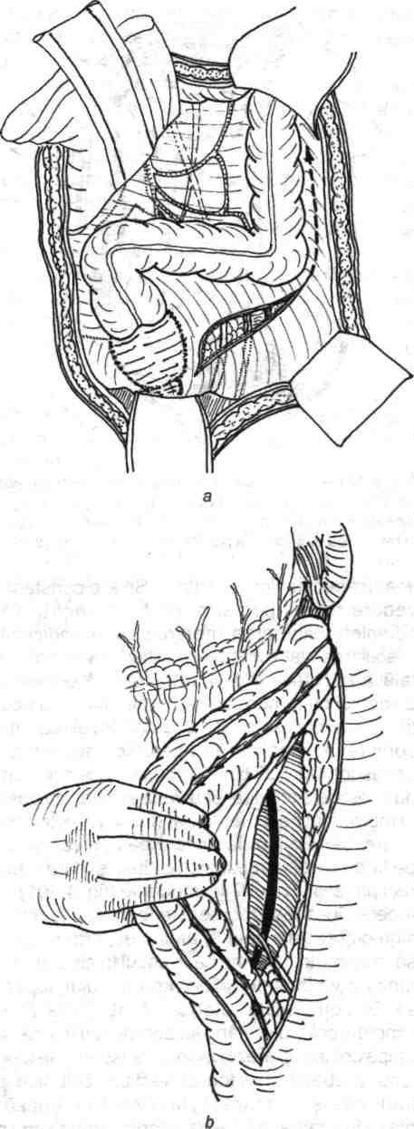 Chirurgia de exereză conservatoare colorectală 97 Fig. 4.119 - Disecţia spaţiului retroperitoneal din spaţiul (firida) mezenterico-colonic stâng. după incizia peritoneală descrisă.
