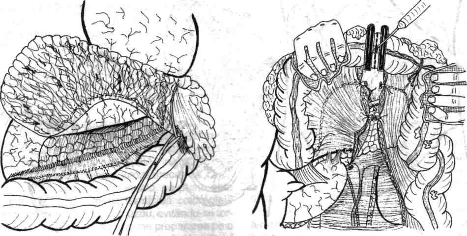 Secţionarea mezocolonului transvers şi a arcadei vasculare marginale se execută numai după verificarea încă o dată a sistemului vascular restant din teritoriul drept, vascularizat de artera