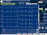The extra leads aid in detection of ECG changes of ischemia which are difficult to detect with standard ECG.