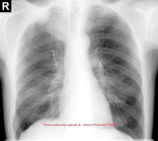 (Pancoast-Tobias) Figura 39. Tumoră pulmonară apicală dr.