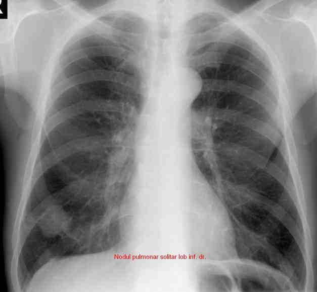 Nodulul pulmonar solitar şi opacităţile în geam mat.