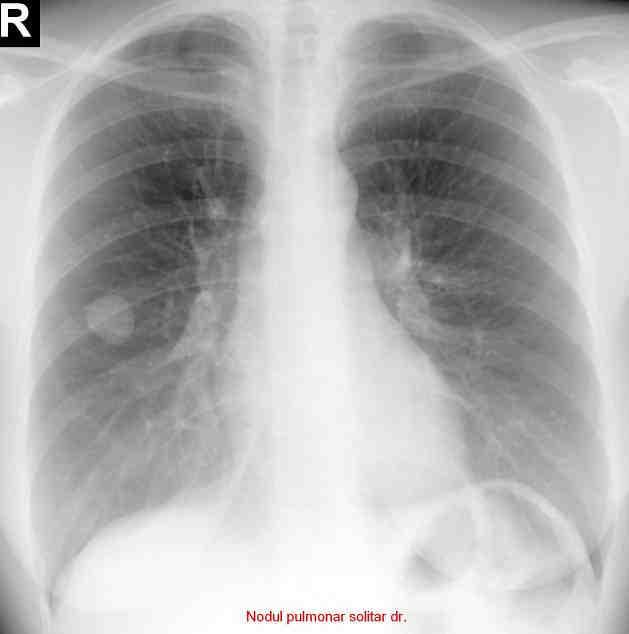 Deoarece aproximativ 35% dintre aceste leziuni sunt maligne, diagnosticul diferenţial trebuie tratat cu multă seriozitate. Figura 36. Nodul pulmonar solitar bazal dr. Figura 37.
