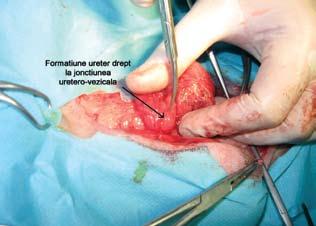 Imaginea ecografică pune în evidenţă ureterul dilatat şi formaţiunea obstructivă Figura 2.