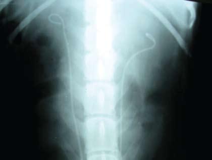 urologie Figura 6. Imagine radiologică a verificării poziţionării implanturilor Prin laparotomie pe linia mediană s-au pus în evidenţă ambele uretere şi vezica urinară.