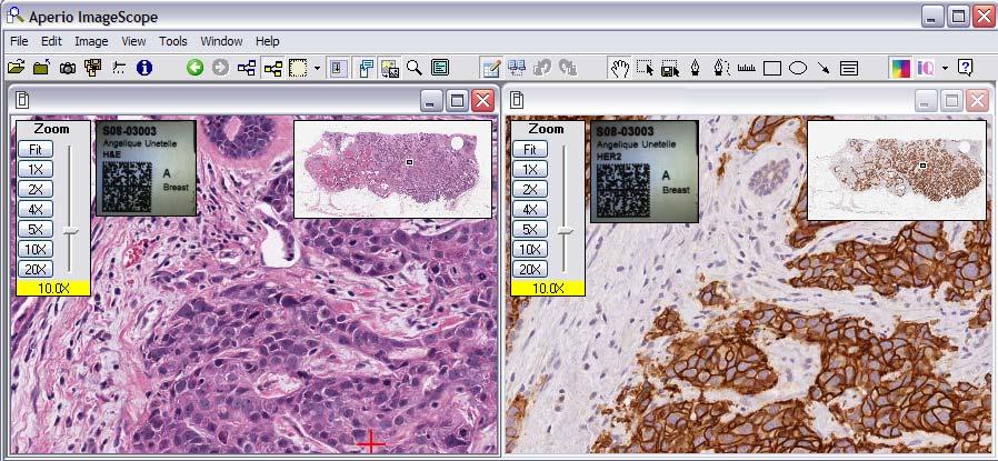 Being able to view the H&E and IHC slides side by side can help you to identify the tumor regions faster and more reliably.