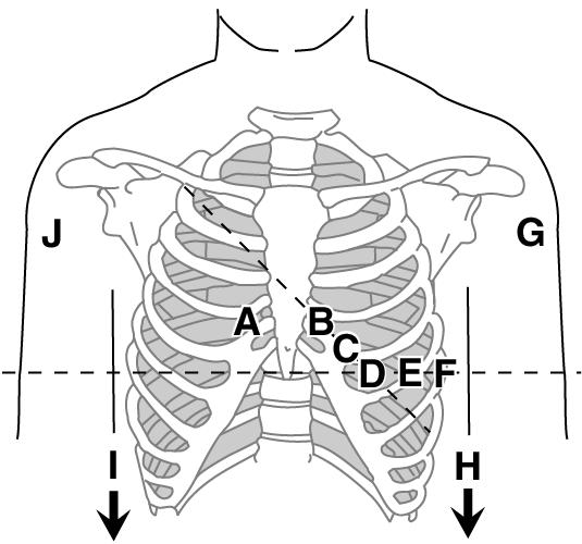 Step 3: The participant will need to remove or open their shirt so that you can access their chest. The wrists and ankles also need to be accessible for lead placement.