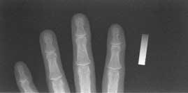 Images of the patient s fingers are scanned using the ACLxy as the input source for reports.