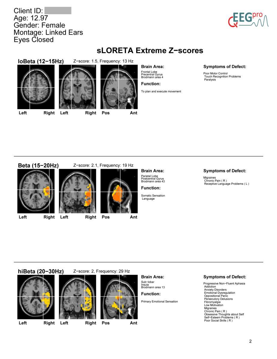 20. sloreta reports Source reconstructions for all discrete frequencies between 1 and 45 Hz for all EEGs in the qeeg-pro database were performed using standardized low resolution brain
