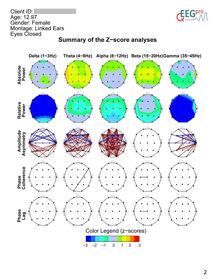 2. Summary In section 2 of the qeeg-pro report, a summary of the Z-scored results is depicted.