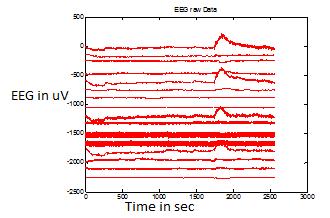 69 Figure 5: Raw EEG signal with forehead movement EMG artifact of Subject 5 Figure