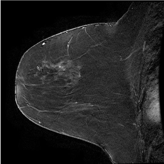 3D T1 post-contrast dynamic, fat sat Left breast Right breast Center frequency = 128,173,593 Hz Good fat saturation achieved on