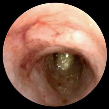 4: Biopsy of colonic mucosa for