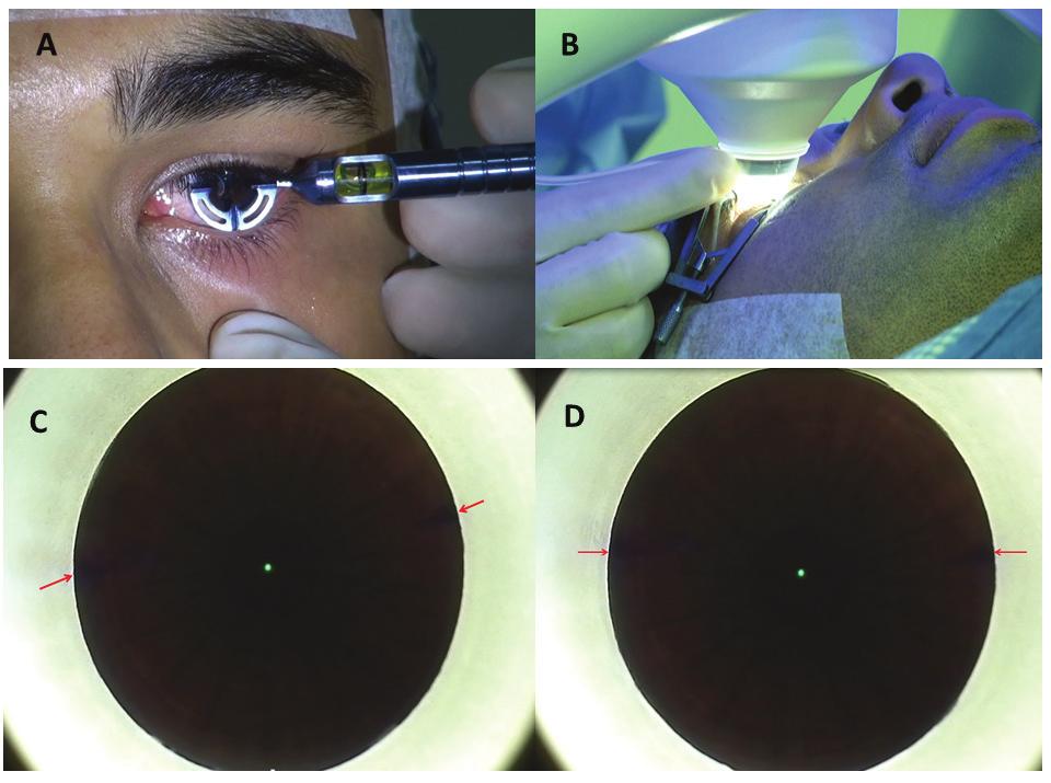 Figure A. (A) Preoperative limbal marking with the Ganesh bubble marker (Epsilon Surgical, Chino, CA) under topical anesthesia in the upright position.