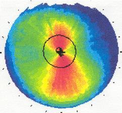 Excimer Laser Ablation Astigmatic Ablation Astigmatism Torus = sphere + cylinder Flatten steep axis