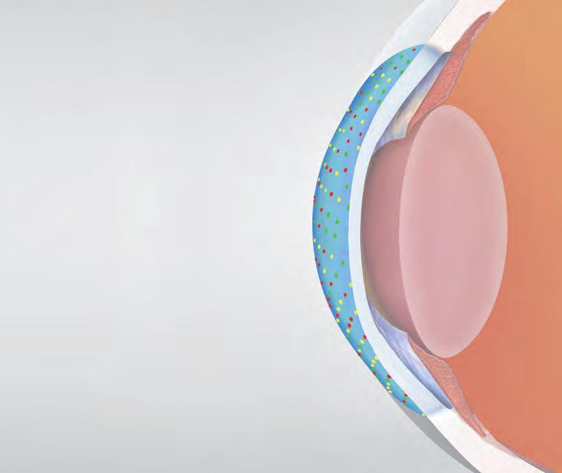 Total Corneal Astigmatism Cassini uses patented multi-colored LED point-to-point ray tracing to provide a GPS-like analysis of the cornea along with high-resolution images utilized for surgical