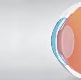 Increase your Confidence Addressing the four most common problems when correcting astigmatism* Post-op measurement Pre-op measurements The accurate post-op Cassini measurements enable the surgeon to