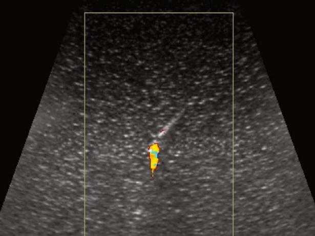 Twinkling rtifact and Clinical Use C D Fig. 10. The twinkling artifact improves the visualization of the needle tip in sonographically guided puncture.