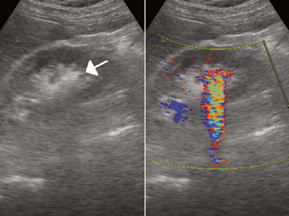 Color Doppler ultrasound shows the twinkling artifact located at the site where one finds an acoustic shadow (right panel).