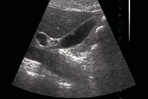 About Ultrasound Modes The Terason software supports the following scan modes: 2D Mode M-Mode (Motion Mode)Color Doppler Triplex Pulsed-Wave Doppler Omni Beam TeraVision 2D Mode The Terason usmart