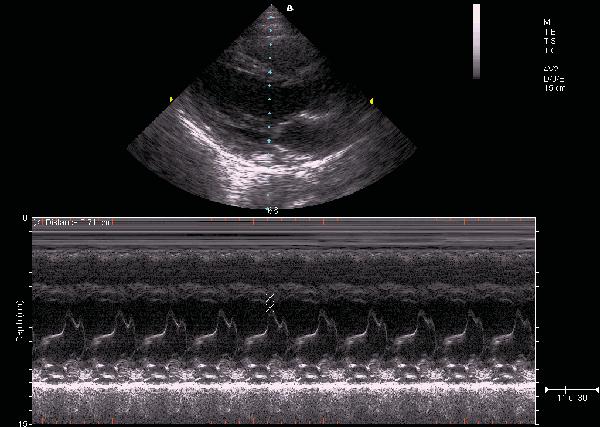 About Ultrasound Modes M-Mode displays scan data of the anatomy in the 2D Imaging window, and the motion scan in the Time Series window. The following figure shows a sample M-Mode scan.