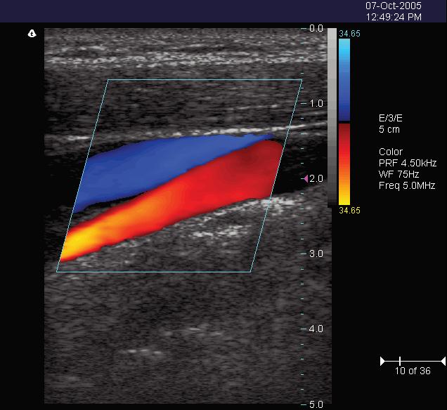 About Ultrasound Modes The Color Doppler scan data displays in the 2D Imaging window. The following figure shows a sample Color Doppler scan.