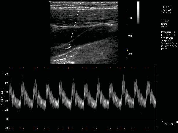 About Ultrasound Modes Example Pulsed-Wave Doppler Scan In the 2D scan, the long line lets you adjust the ultrasound cursor position, the two parallel lines (that look like =) let you adjust the