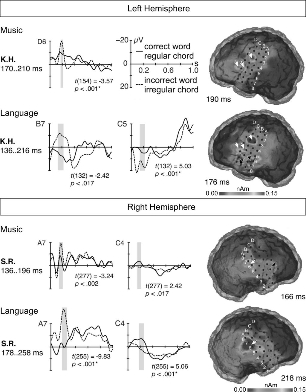 496 Annals of the New York Academy of Sciences Figure 1. Music and language data (for the sake of brevity shown for only two representative patients): K.H. with left (upper panel) and S.R.