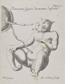 108 SYDENHAM, THOMAS. 1624-1689. Tractatus de podagra et hydrope. London: R. N. for G. Kettilby, 1683. 8vo (175 x 97 mm). [10], 201, [1] pp. Full antique calf, gilt. Custom quarter morocco slipcase.