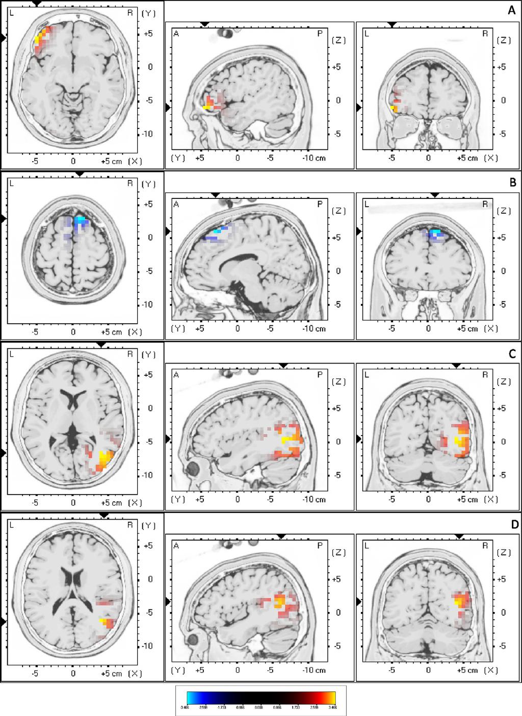 S. Vanneste et al. / Clinical Neurophysiology 122 (2011) 578 587 581 Fig. 1. sloreta contrast analysis between unilateral versus bilateral tinnitus (p <.05): (a) increased delta (1 3.