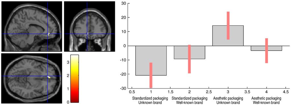 Significantly stronger brain activations in the ventromedial prefrontal cortex (A), striatum, particularly nucleus accumbens (B), cingulate cortex (C), primary visual cortices (D), and precuneus (E)
