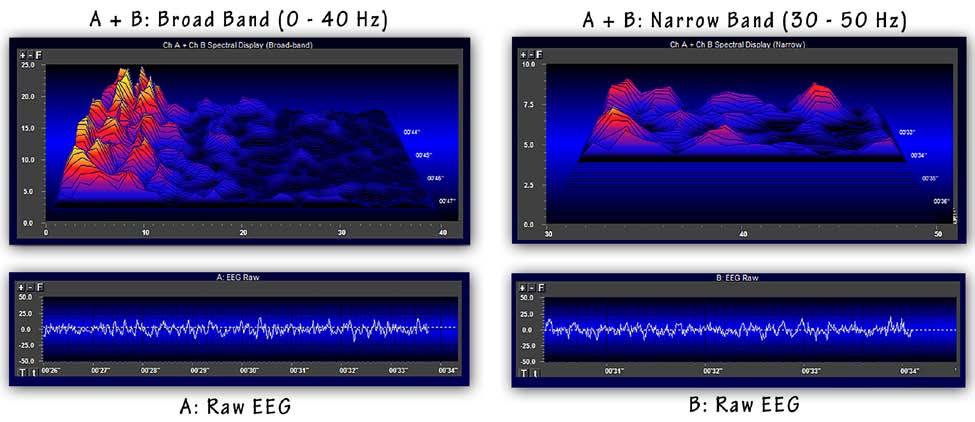 Figure 6 - Note that the spectral displays are not individually associated with the raw EEGs shown immediately below them.