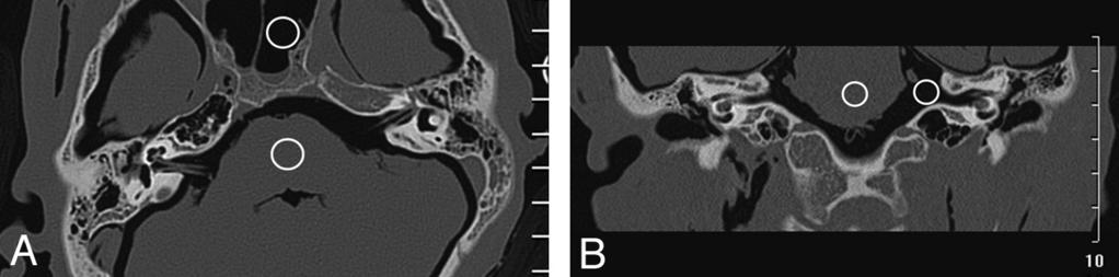 Fig 1. ROIs in the brain stem and air were used to calculate the for each image. Example ROIs are shown in an axial (A) and the coronal (B) reformatted images here. line.