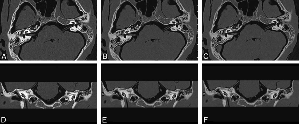 Fig 2. (A C ) and coronal (D F ) images reformatted from helical temporal bone scans. Each scan was performed with a similar CTDI vol but a different tube voltage.