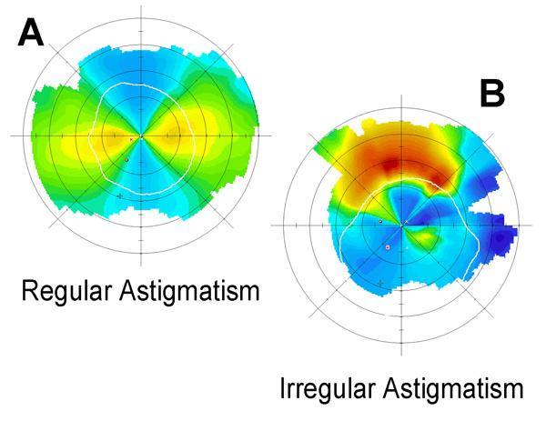 Contact Lens Correction of Regular and Irregular Astigmatism 159 Fig. 1. Corneal topographies in regular and irregular astigmatisms. A: Regular astigmatism of 4.
