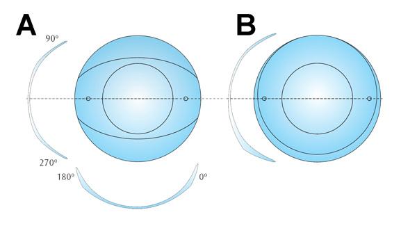 Contact Lens Correction of Regular and Irregular Astigmatism 161 higher refractive astigmatism than corneal astigmatism, an important amount of residual astigmatism (related to lenticular