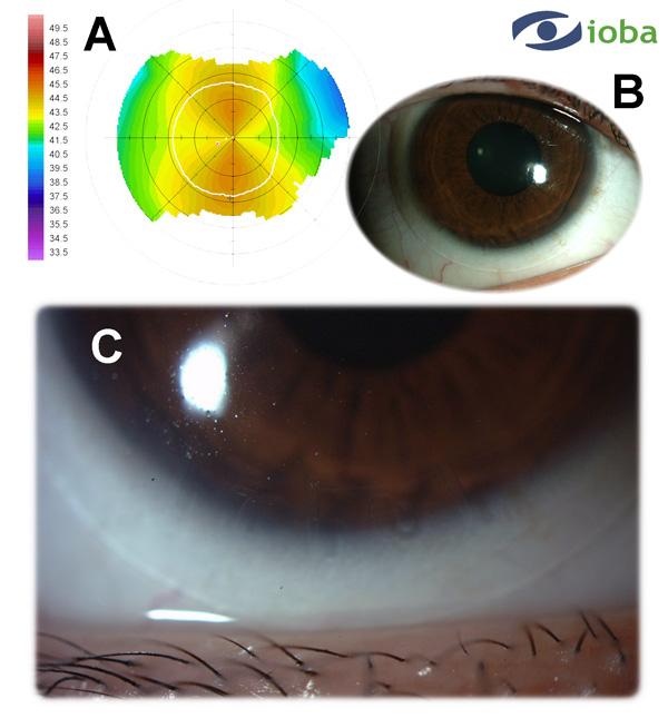 Contact Lens Correction of Regular and Irregular Astigmatism 165 Fig. 5. Summary of Case 1. A. Detail of the corneal topography of 2.00 D regular with-therule astigmatism. B.