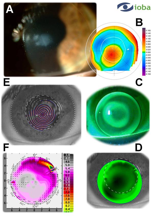 172 Diagnosis and Management of Astigmatism Fig. 9. Summary of Case 5. A. Slit lamp examination showed corneal leucoma in the central area that affects the pupil axis. B.