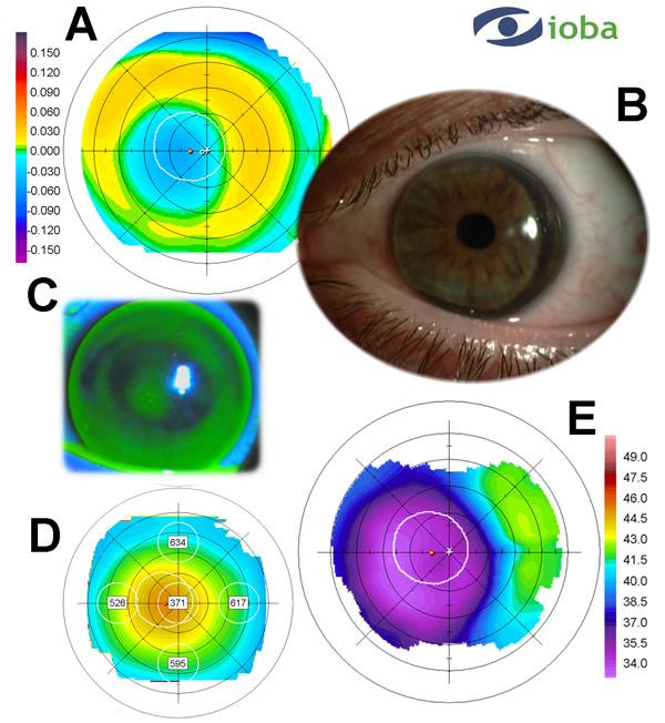 Contact Lens Correction of Regular and Irregular Astigmatism 175 Fig. 11. A summary of Case 7. A. Orbscan elevation topography showed the decentered ablation of the excimer laser. B.