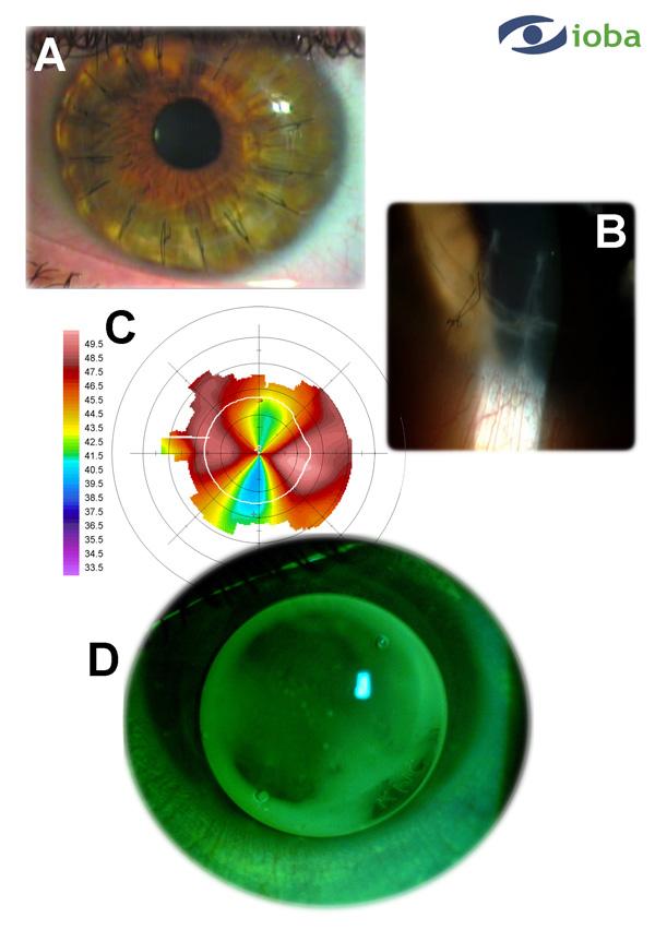 Contact Lens Correction of Regular and Irregular Astigmatism 177 Fig. 12. A summary of Case 8. A. Slit lamp examination showed the penetrating keratoplasty. B.