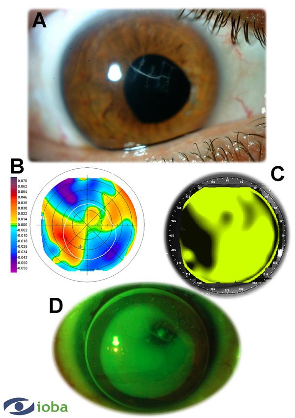 Contact Lens Correction of Regular and Irregular Astigmatism 179 Fig. 13. A summary of Case 9. A. Slit lamp examination showed corneal scarring in the central area that affect the pupil axis. B.