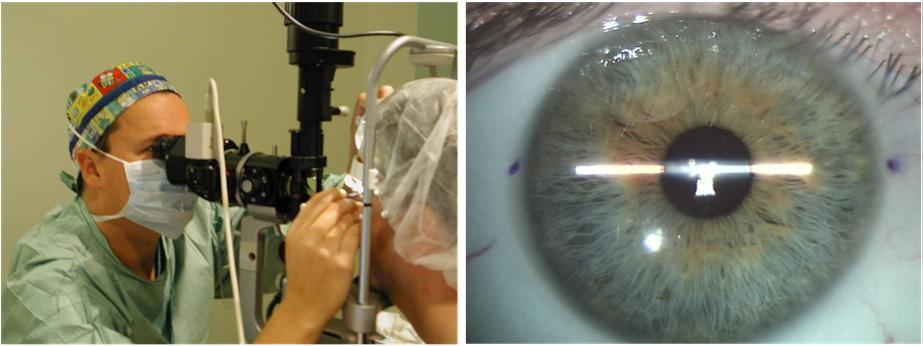 186 Diagnosis and Management of Astigmatism Fig. 3. Preoperative marking of the eye s horizontal axis prior to Toric ICL implantation Fig. 4.