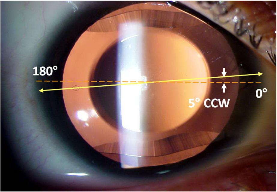 The arrows indicate that the surgeon aligned the lens at 5 CCW from the horizontal meridian. 3.