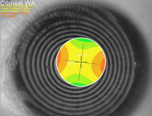 Bottom left: 4mm diameter refractive irregular astigmatism measured at the pupil centre showing 4.
