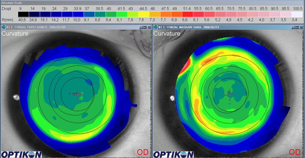 216 Diagnosis and Management of Astigmatism Fig. 14. Comparison of topographical findings after centration at the pupil centre and corneal vertex, respectively.