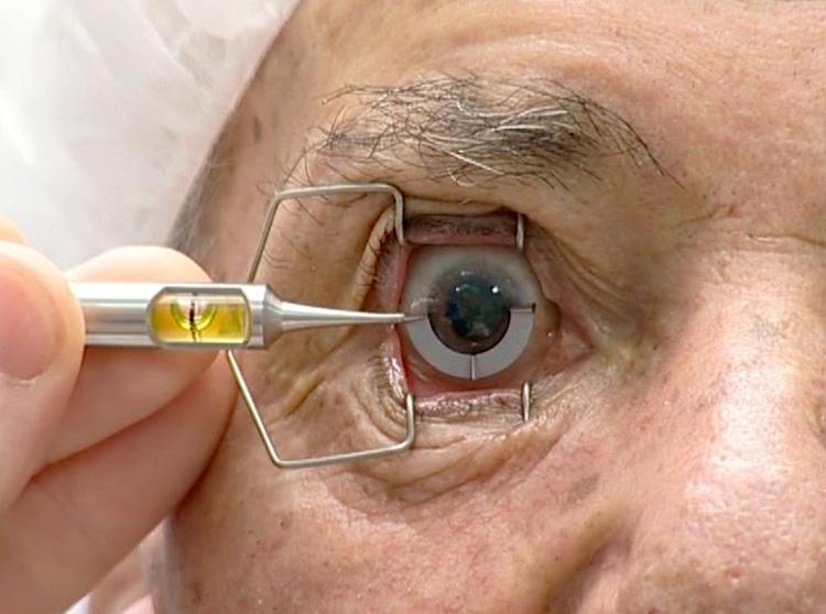 254 Diagnosis and Management of Astigmatism limbus is than marked at the horizontal position with either a sterile ink pen or a needle.