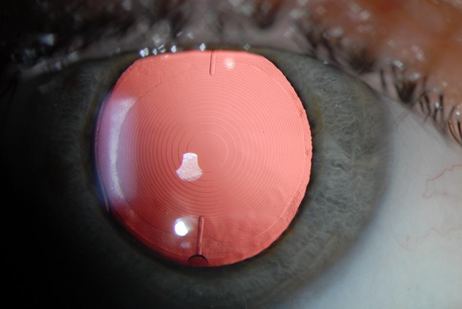 Toric Intraocular Lenses in Cataract Surgery 263 sector-shaped nearvision segment. So far, two studies have been published on multifocal toric IOLs.